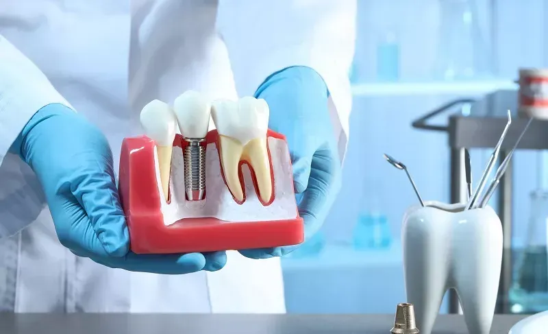 The Best Low Cost Dental Implants in My Area