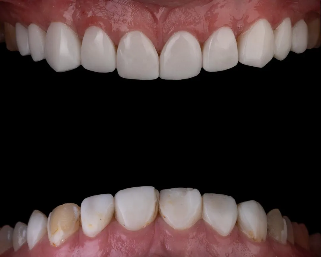 natural look dentures