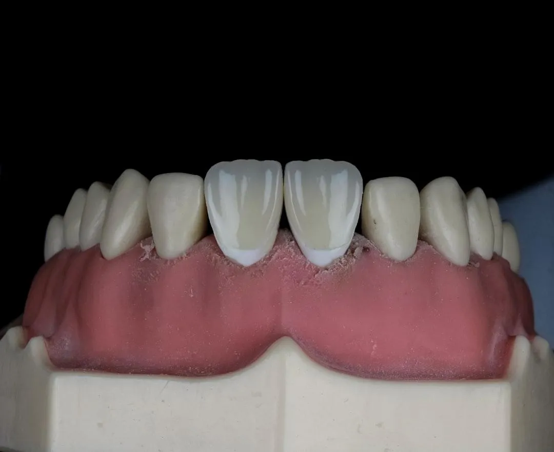 Fix Your Smile Fast with a Temporary Replacement Tooth