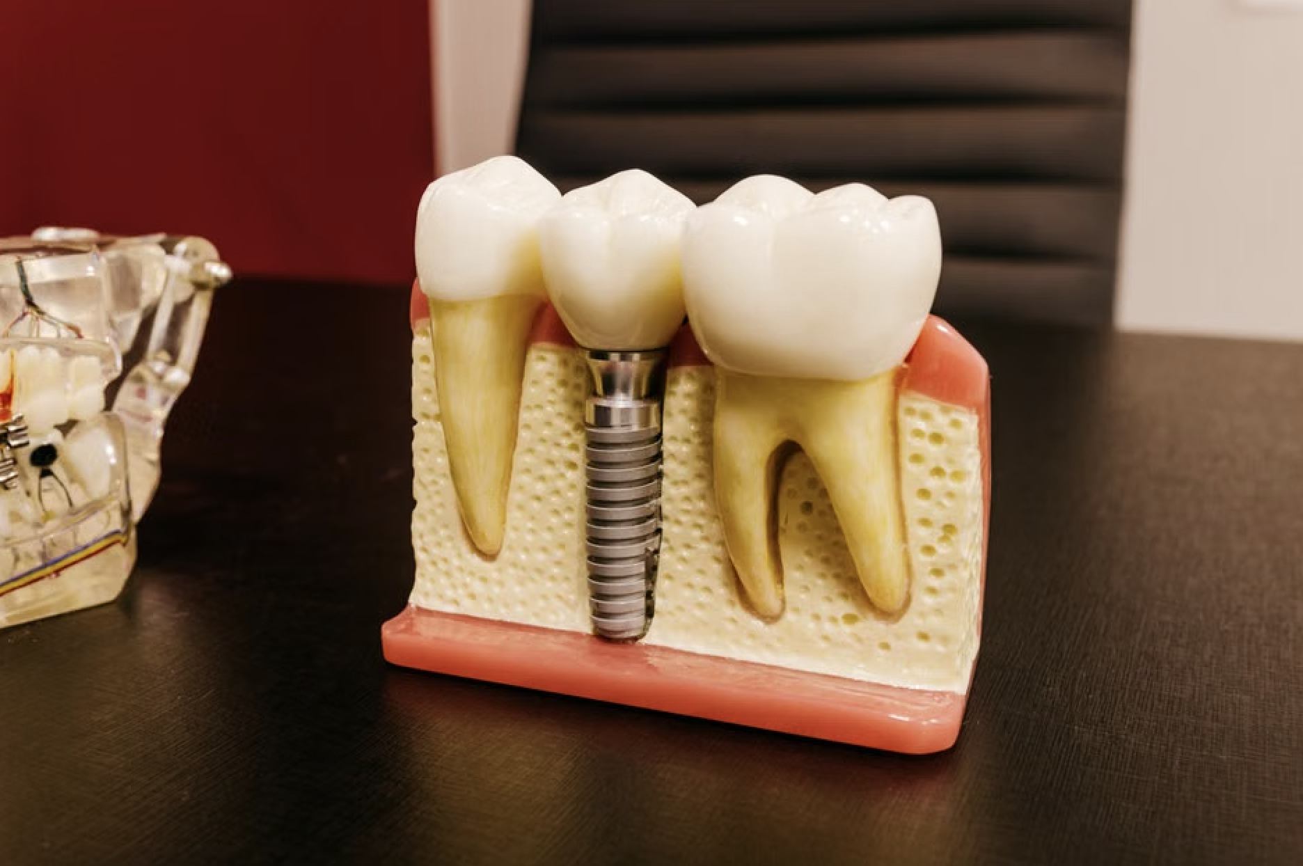 zirconia dental implants