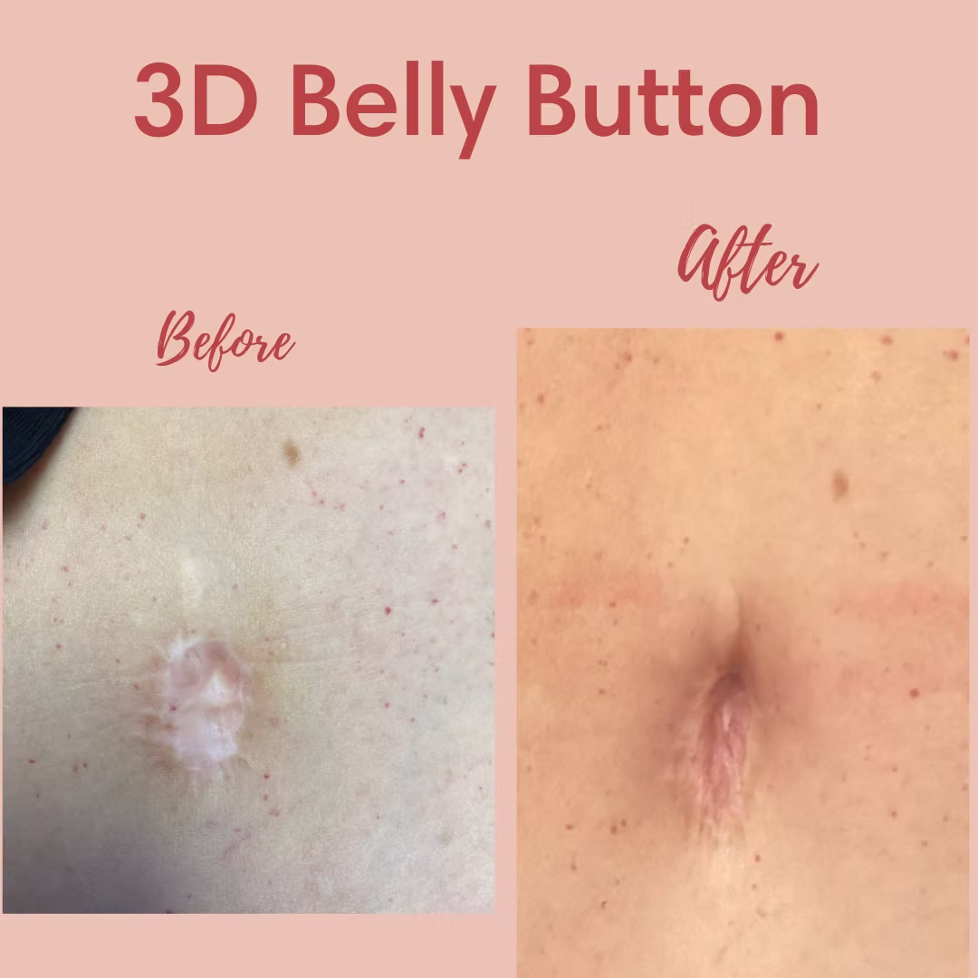 Image of a belly Button Paramedical Tattoo by Terry Lively, CPCP