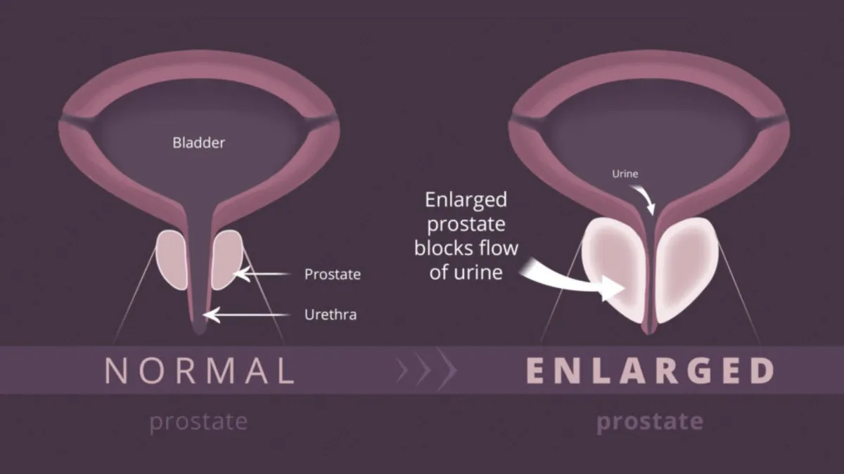 A side-by-side comparison of a normal prostate and an enlarged prostate, showing the difference in size and shape.