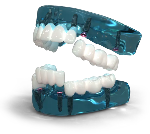 3 on 6 model of implants and bridges