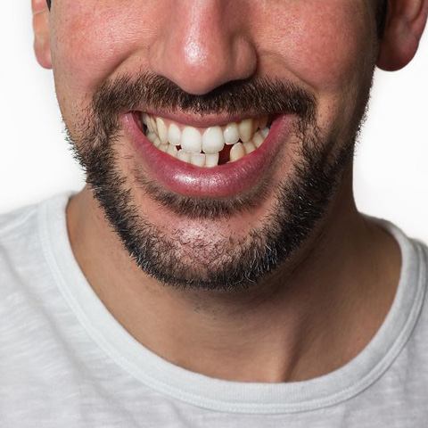Smile with a missing tooth
