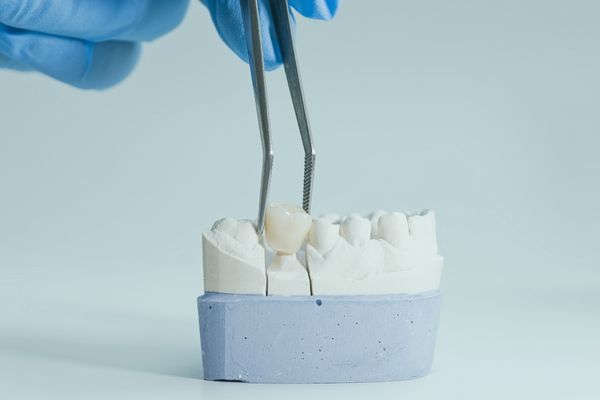 How Tooth Reduction Impacts the Final Restoration