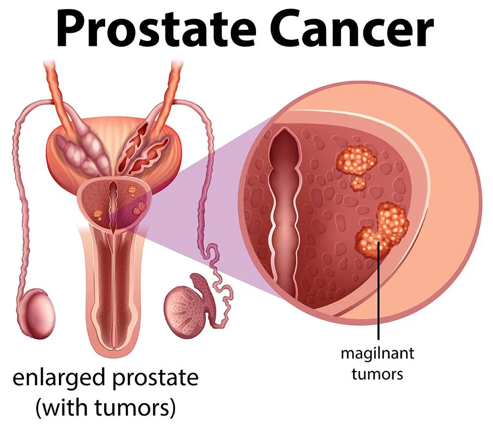 prostate caner image 