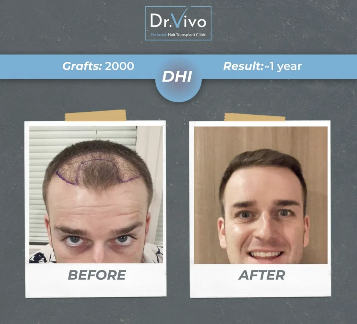 Hair transplant