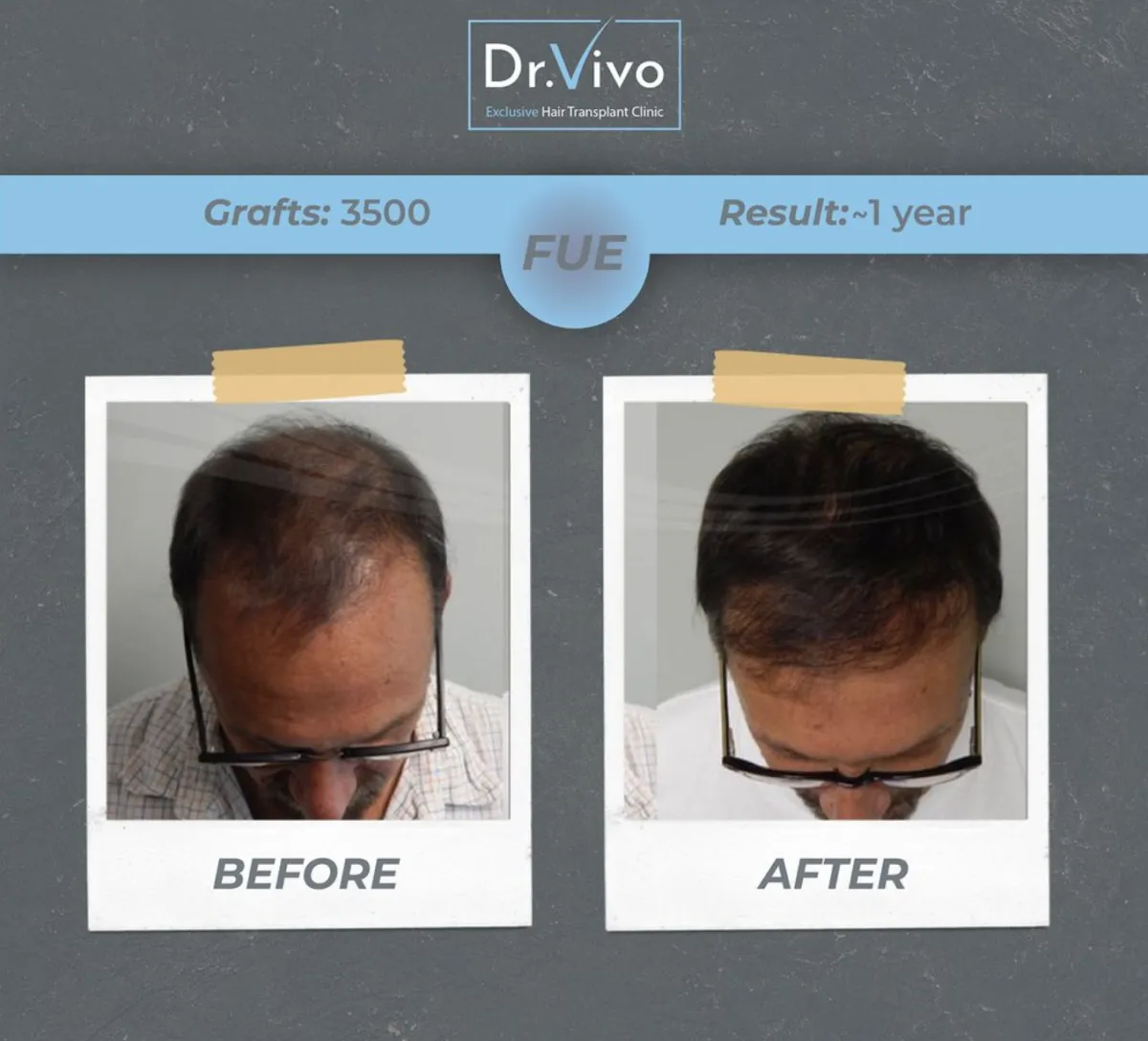 Hair transplant