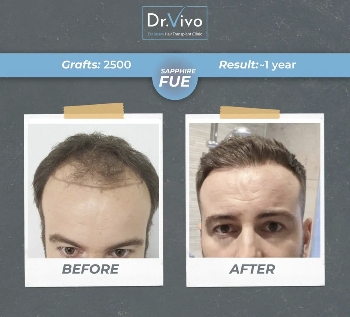 Hair transplant