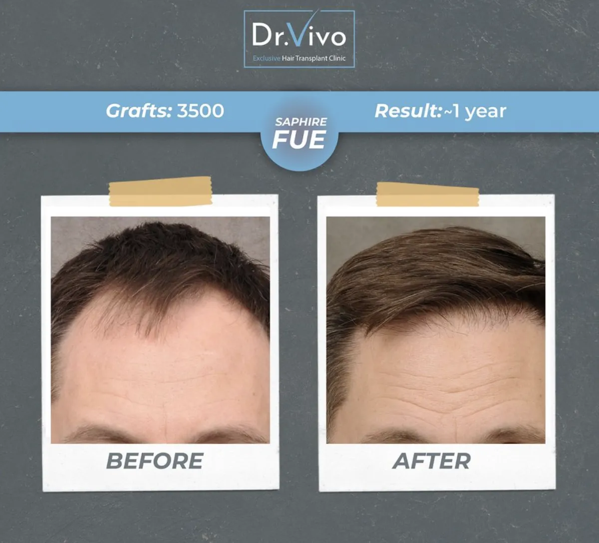 Hair transplant