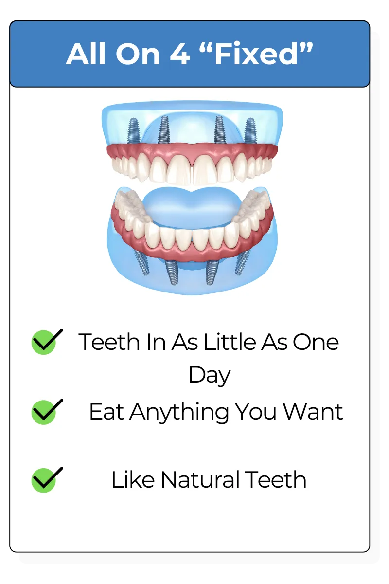 All on Four Dental Implants