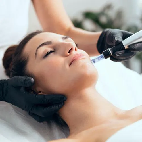 Microneedling and Green Peel, Chemical Peel