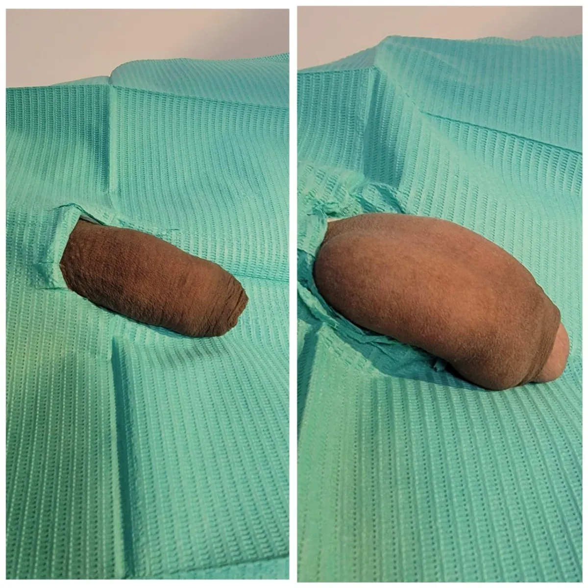 Resultado de paciente - Mamoplastia