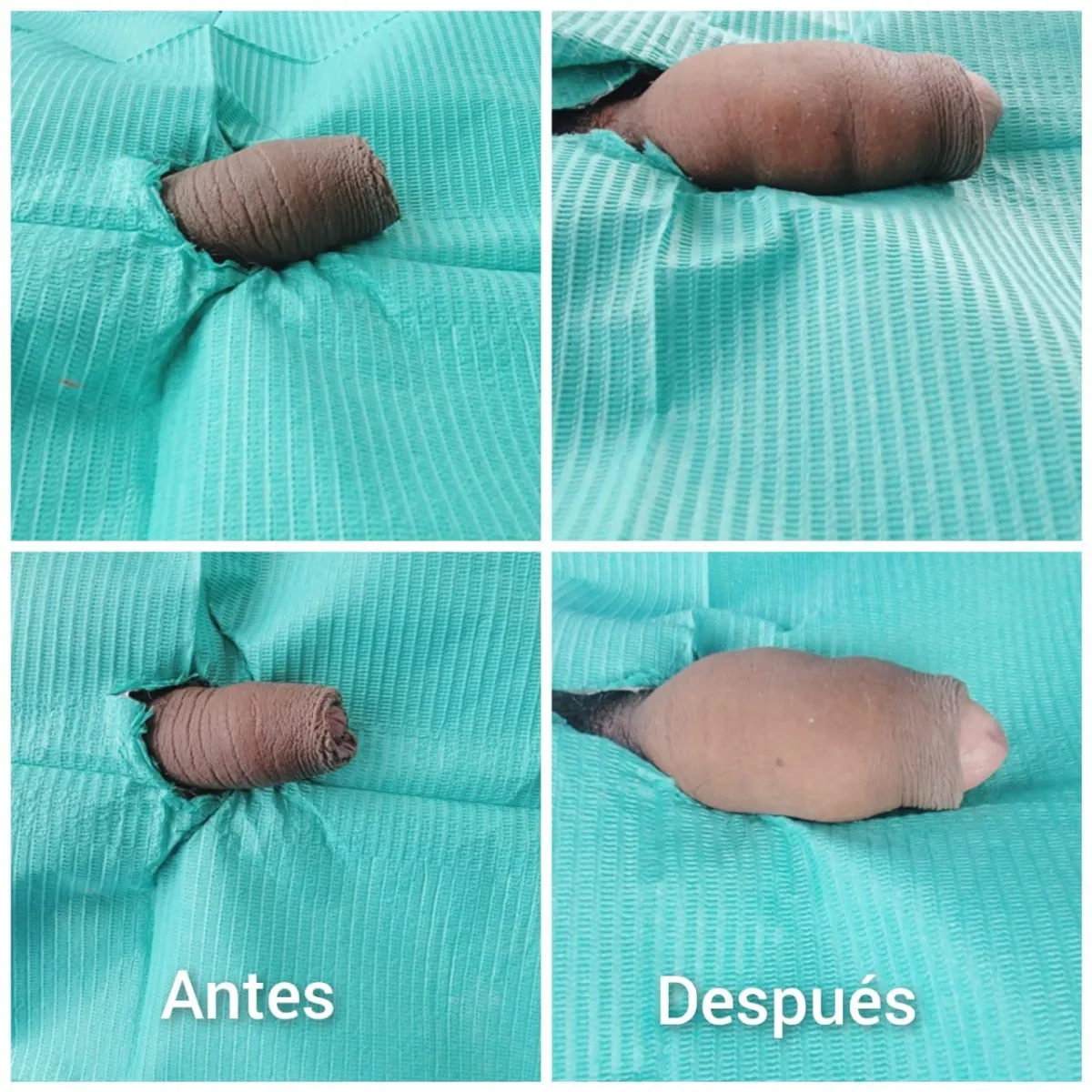 Resultado de paciente - Abdominoplastia