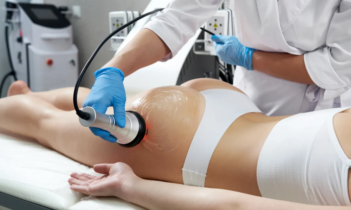 Kavitciós zsírbontás alkalmazása fenék területen