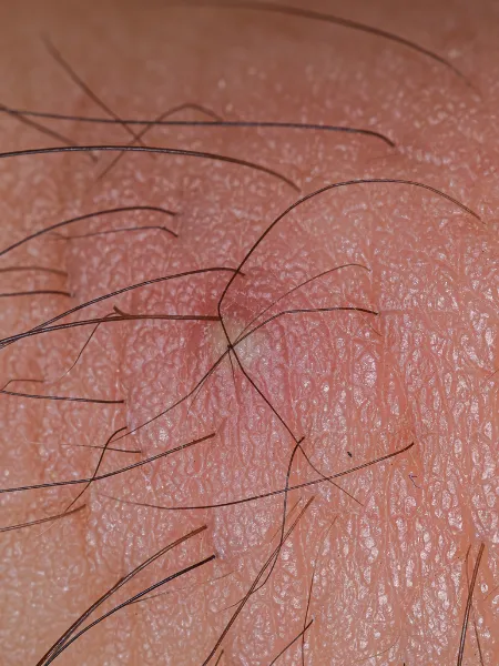 Inflamed and red skin caused by a tick bite