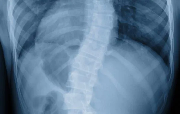 Image of X-Ray Scoliosis Curve Progression