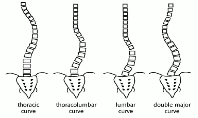 4 Common Curve Types of Scoliosis