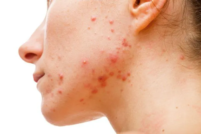 Chocolate is the worst food to eat if you have acne