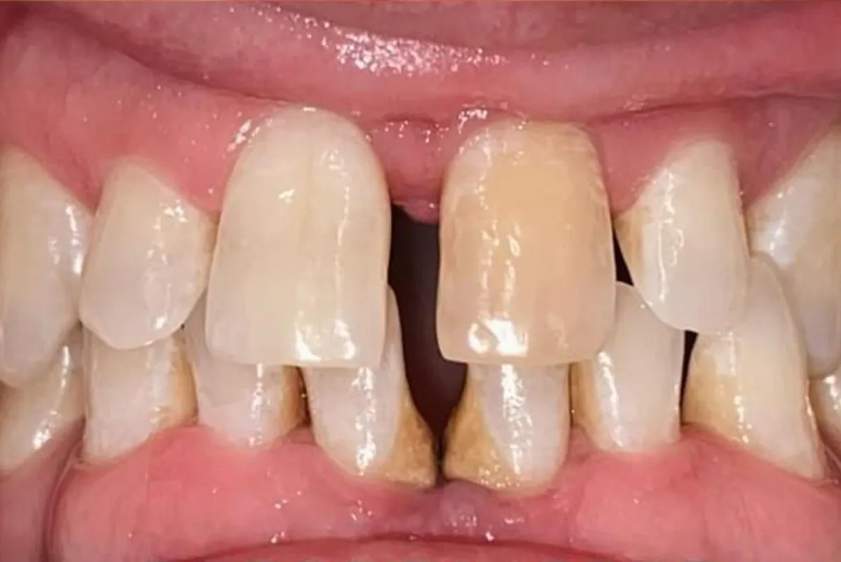 Before dental treatment