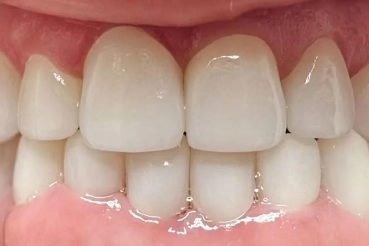 After dental treatment