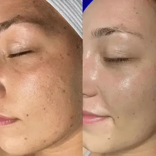 collagen therapy nyc