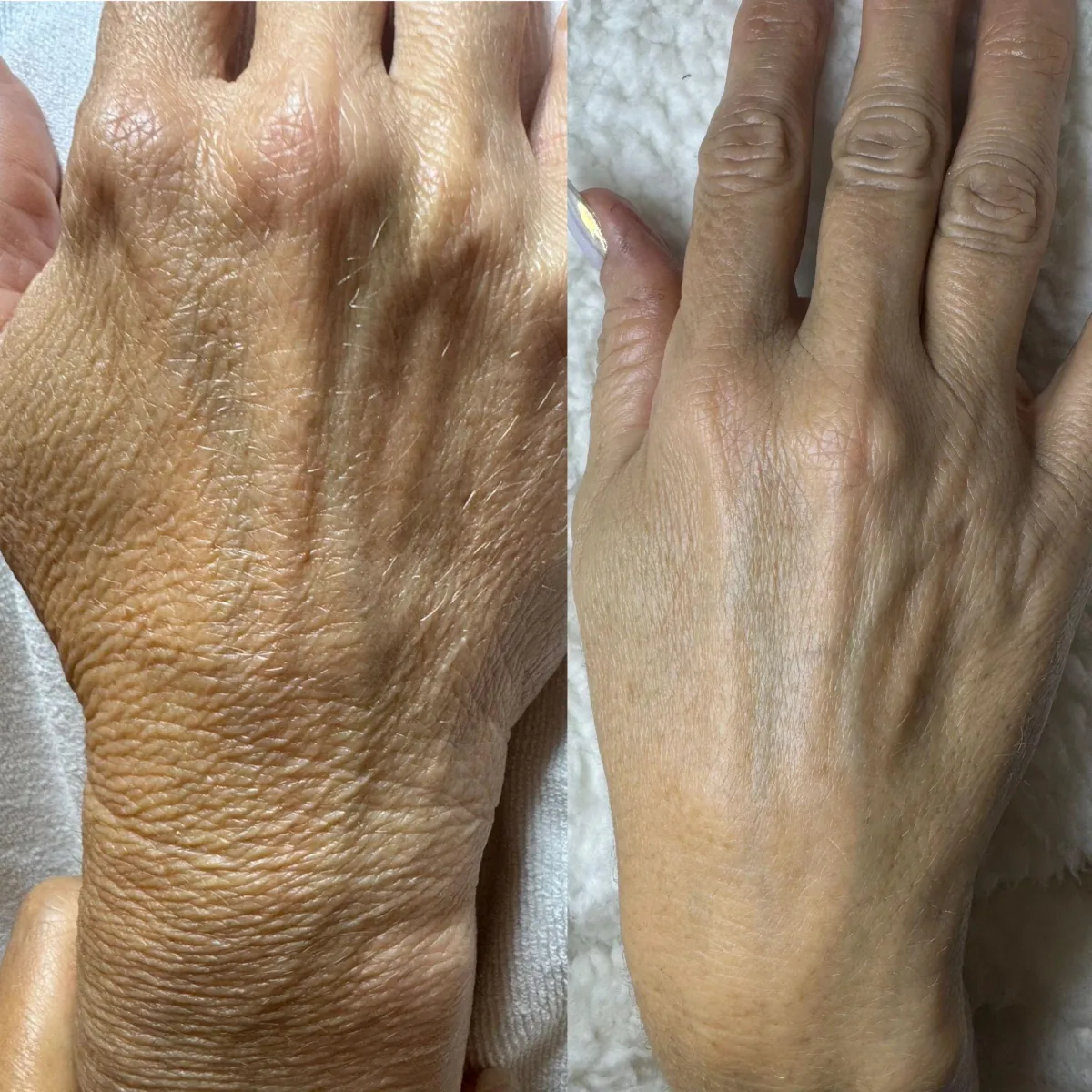 Wrinkle treatment NYC