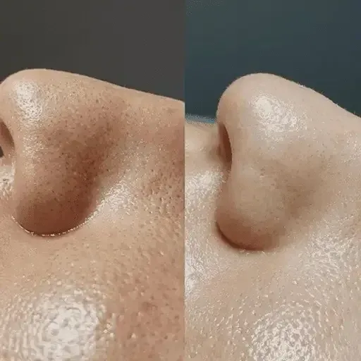 Wrinkle treatment NYC