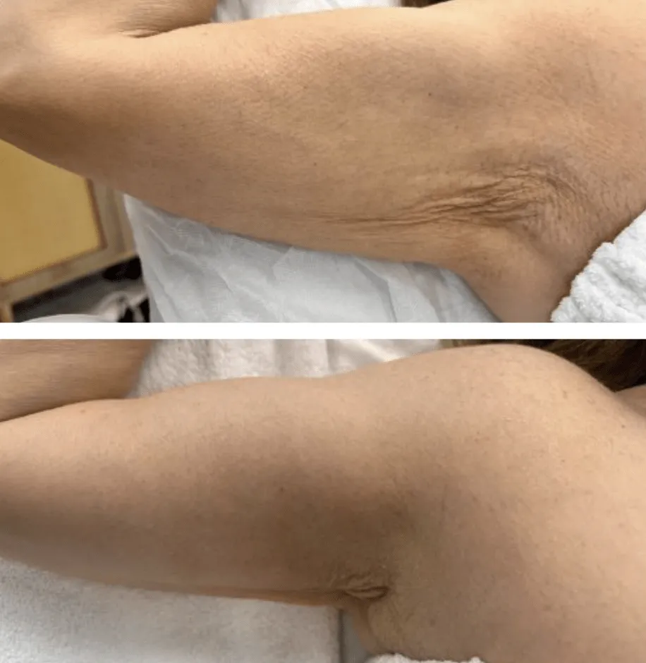 t-shape before & after