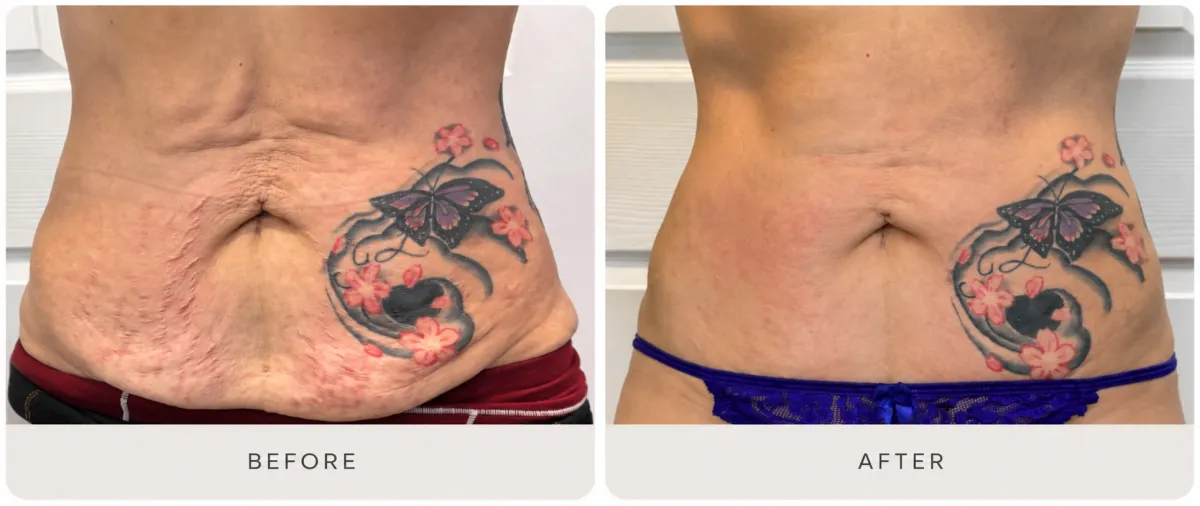 Loren P. — T-Shape 2 before and after results