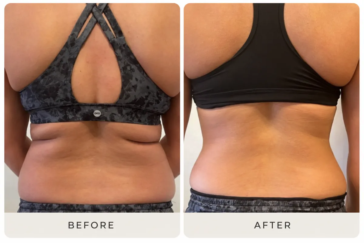 Lindsey H. — T-Shape 2 before and after results