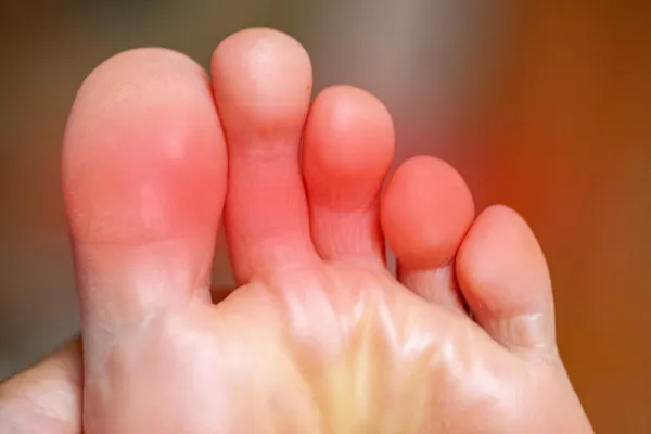 Why Neuropathy Often Starts in the Toes