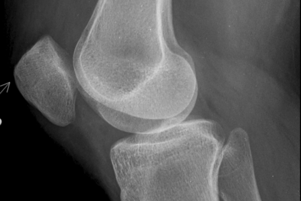bone on bone knee arthritis
