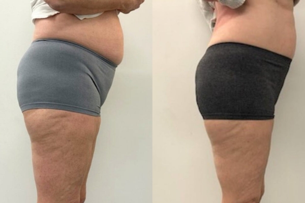 Body Contouring vs Liposuction: What’s the Difference?
