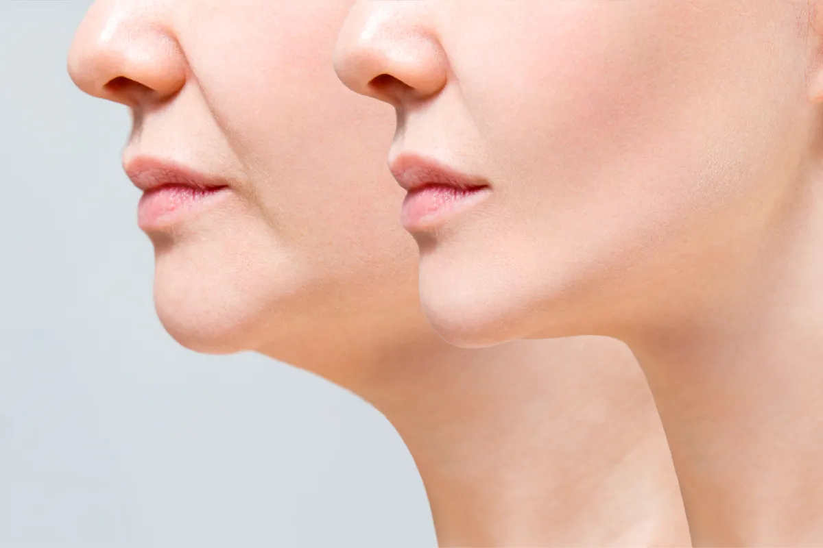 double chin removal
