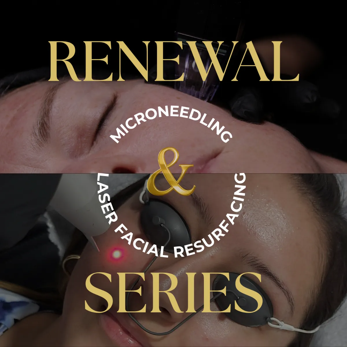 Renewal Series at Bowerman Artistry combines Microneedling and Laser Facial Resurfacing