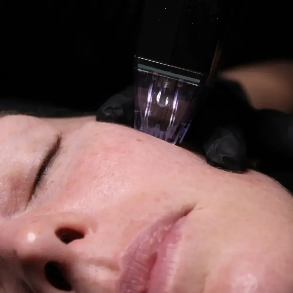 Microneedling treatment performed at Bowerman Artistry as part of a skincare membership in Elkhart Indiana