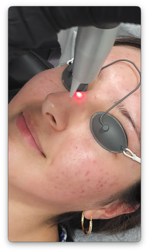 Facials, Laser resurfacing, Esthetician, Bowerman Artistry