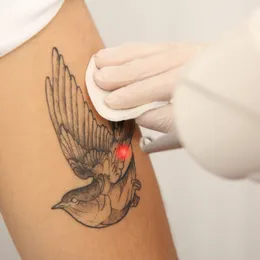 Professionele tattoo removal met laser bij Iris Tattoo Art