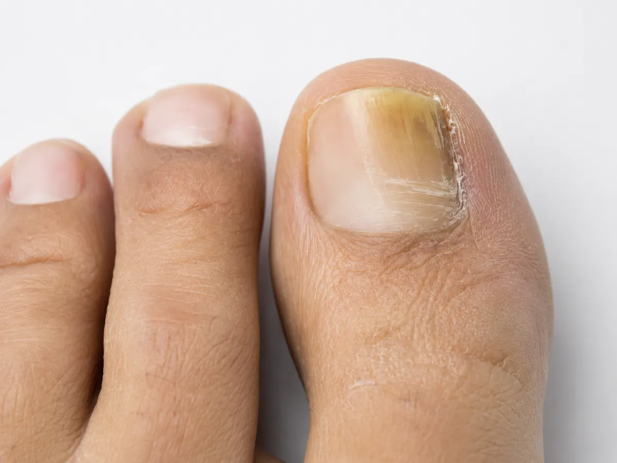 Comfortable person walking outdoors wearing open summer sandals with healthy feet in warm natural sunlight
