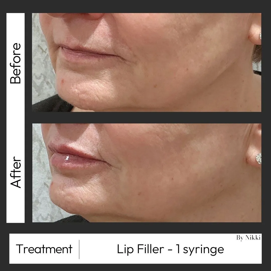 Lip filler before and after at Arvé Aesthetics