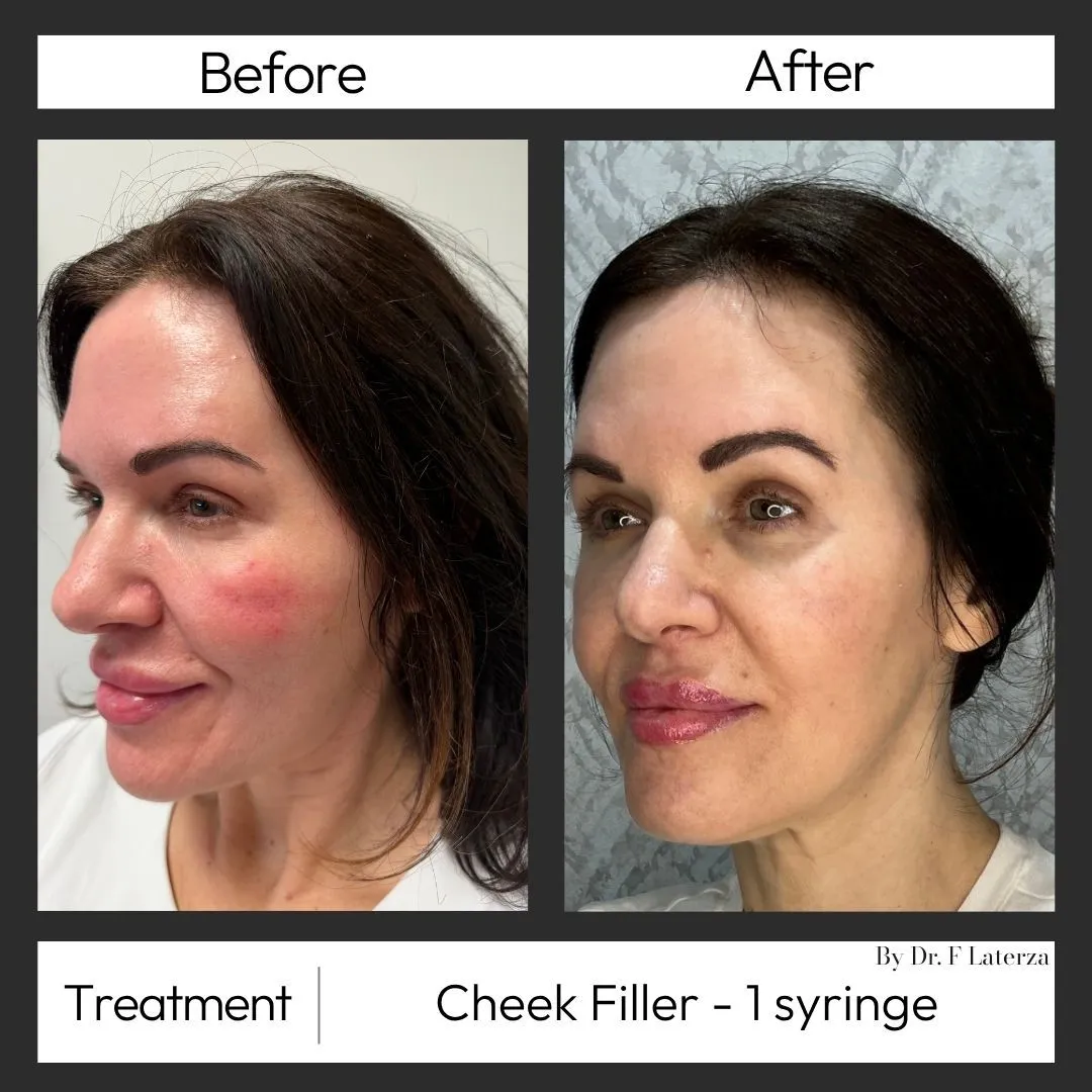 Cheek filler before and after at Arvé Aesthetics