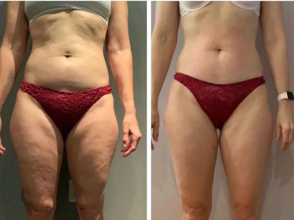 Cryo body sculpting before and after results in Portland