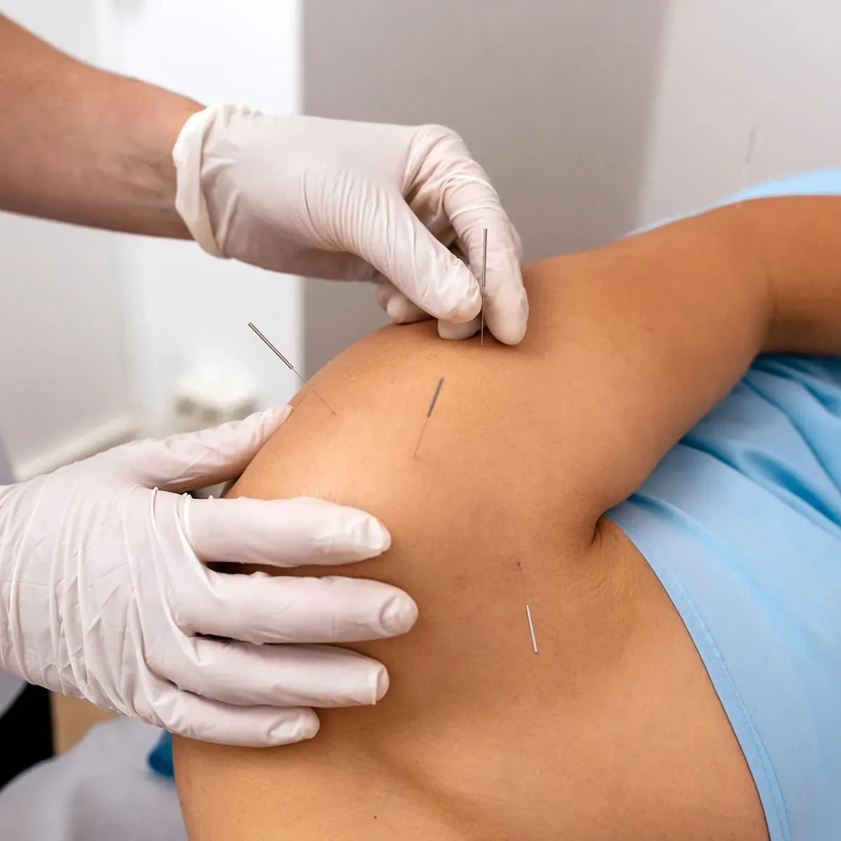 dry needling on the shoulder rotator cuff