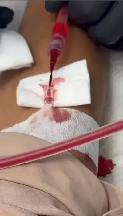 Close-up of IV line connection and gauze dressing during EBO3 blood filtration procedure