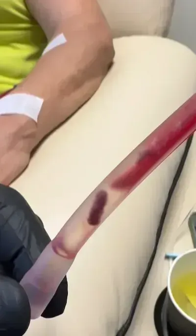 Dark blood microclots visible inside clear IV tubing during Long COVID blood washing therapy
