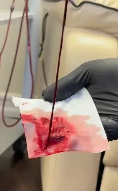 Gloved hands examining extracted microclots and cellular debris filtered from Long COVID patient blood