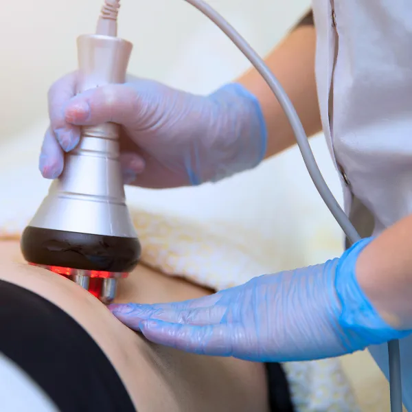 Hyperpigmentation Treatment in Roswell
