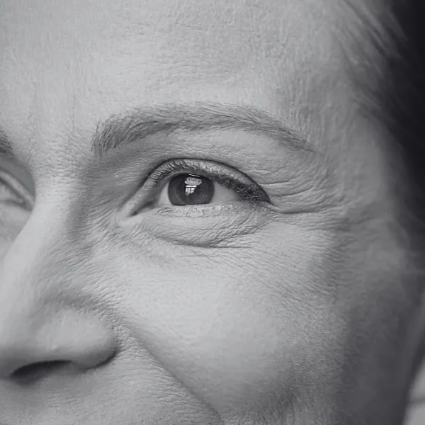 Fine lines and wrinkles