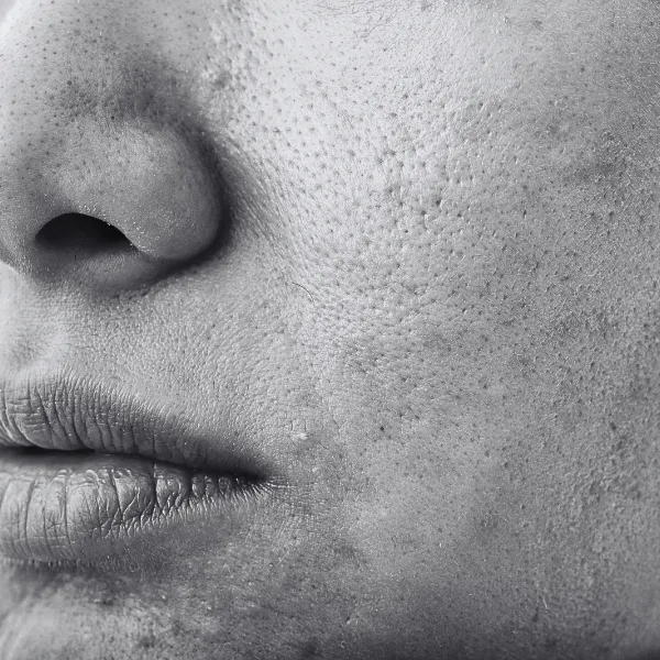 Acne scars and surgical scars